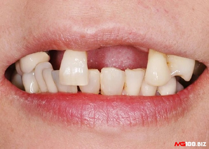 Giải mã khi nằm mơ thấy rụng răng điềm báo gì mang đến cho bạn nhiều con số may mắn mỗi ngày